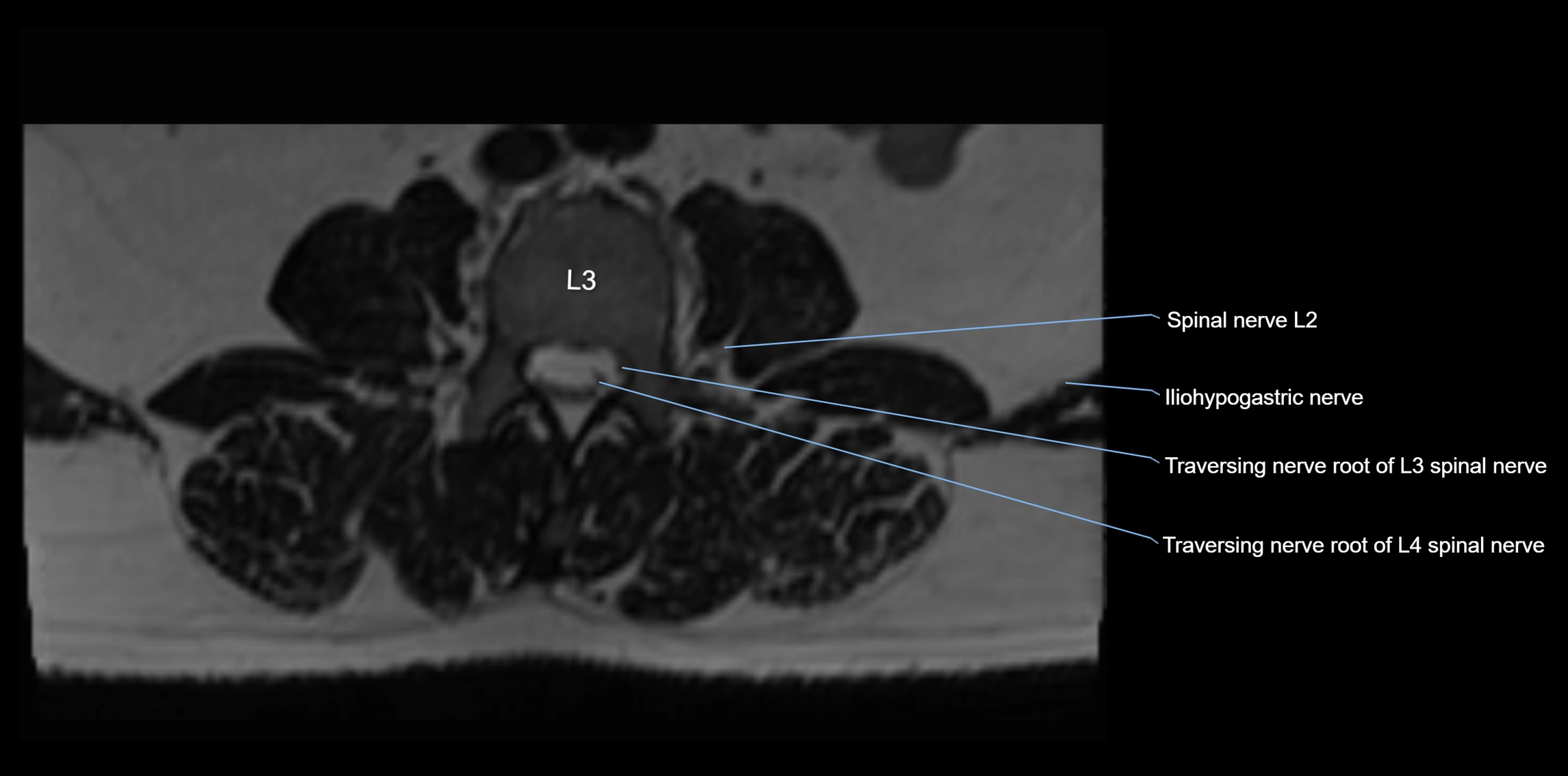 MR lumbosacral plexus axial cross sectional anatomy 3T  radiology  image-img-1008001-00018.webp